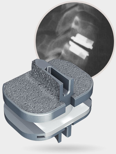 Centinel Spine Prodisc C