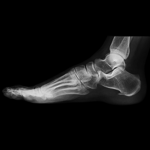 X-ray of foot and ankle