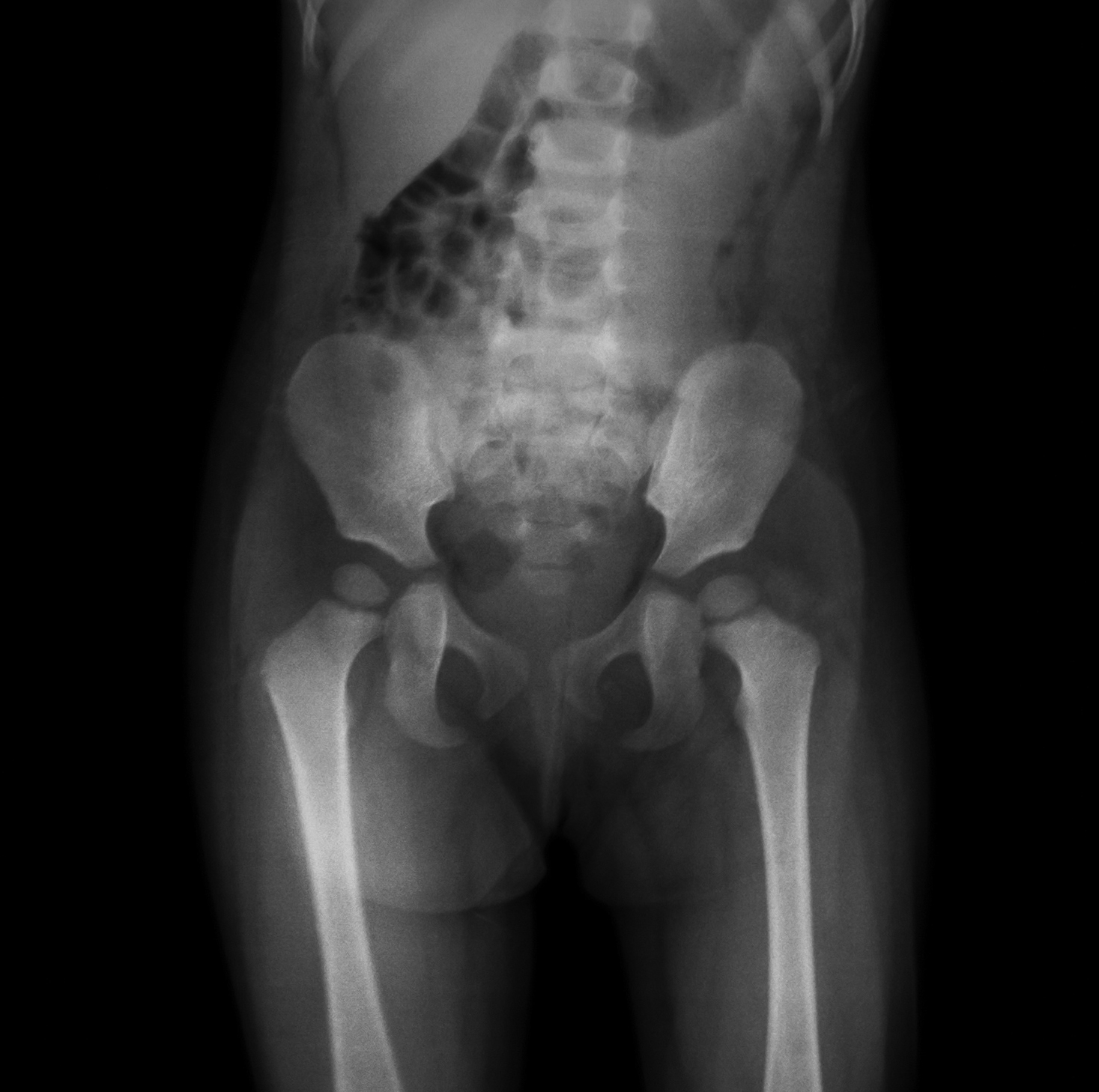 X ray of hip