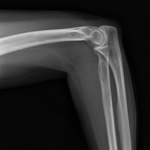 X-ray of knee