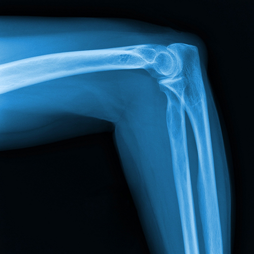 Knee X-ray in blue, black and white tone