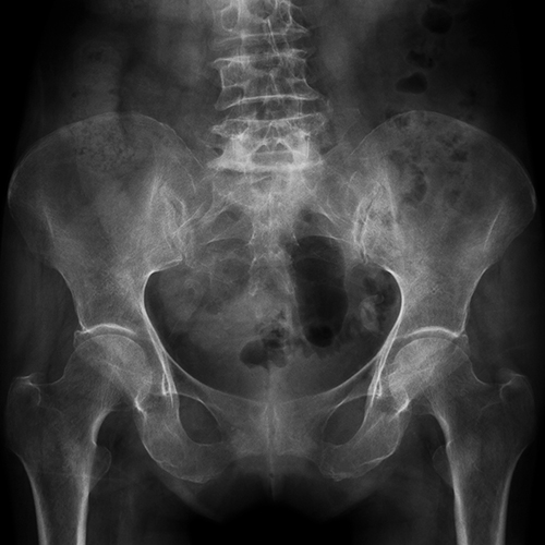 Xray of the lumbar area of the spine