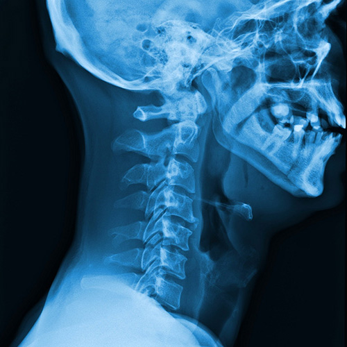 Upper Spine X-ray in blue black and white tone