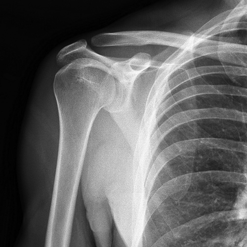 Xray of shoulder