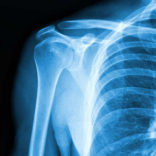 Shoulder X-ray in blue, black and white tone