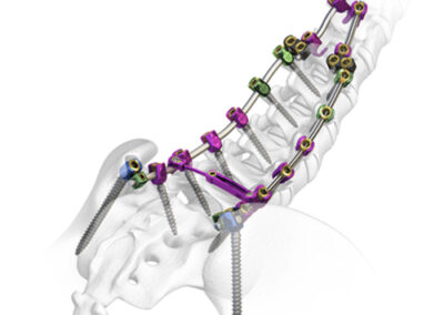 Spinal Elements Mercury Systems