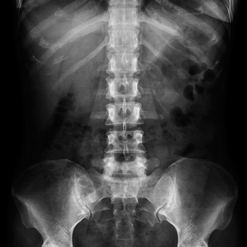 Xray Thoracic area of spine