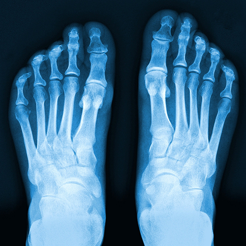 X-ray of feet